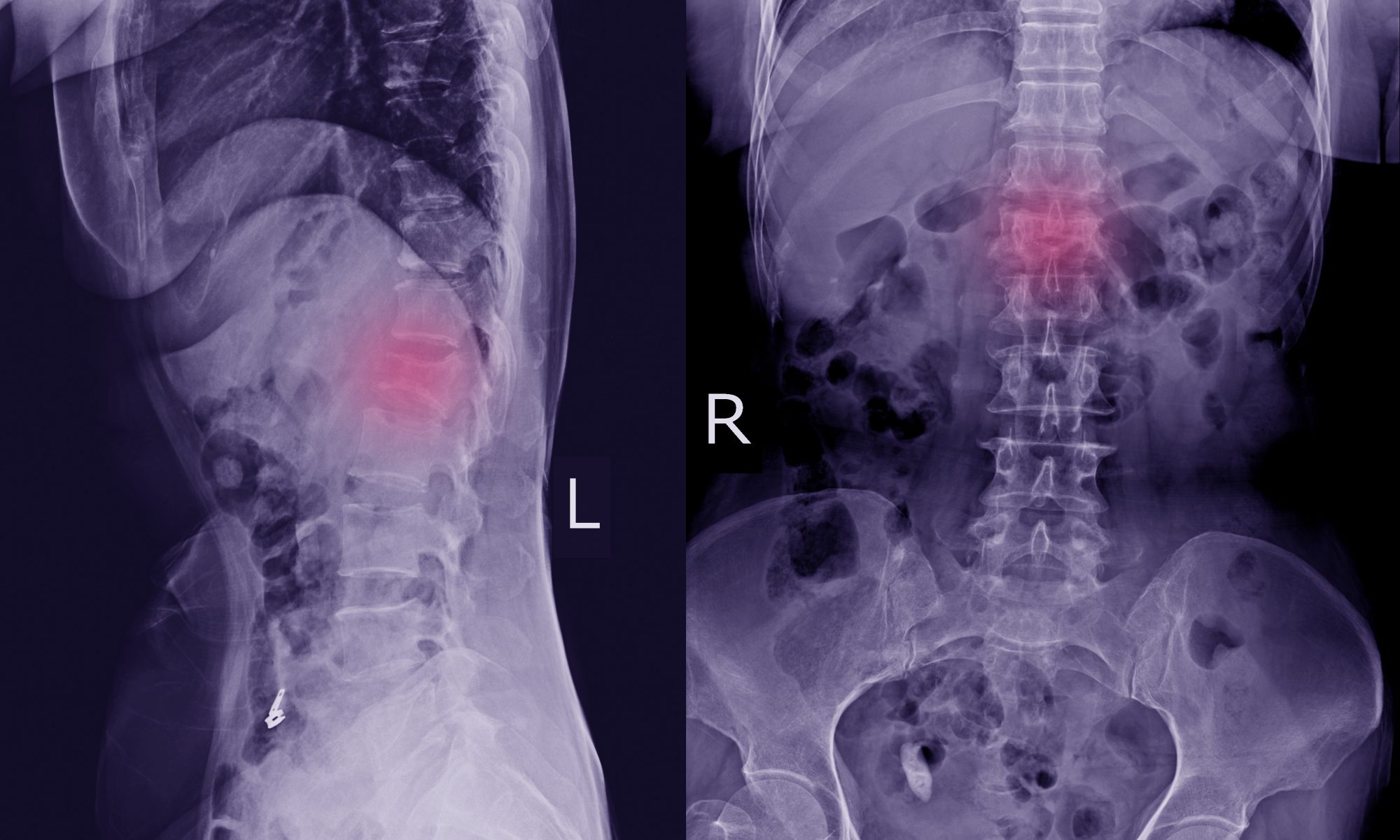 X-ray L-S Spine AP,LATERAL: Finding Moderate compression fracture of L1 vertebra and Lumbar spondylosis; blog: three types of spinal fracture